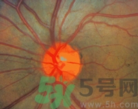 青光眼可以治愈嗎？青光眼怎樣治療？