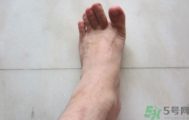腳拇指外翻遺傳嗎？腳拇指外翻怎么矯正？