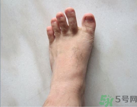 腳拇指外翻遺傳嗎？腳拇指外翻怎么矯正？