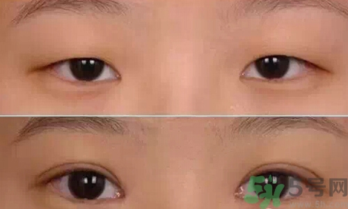 天生腫眼泡怎么消除？天生腫眼泡怎么辦？