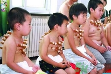 小孩可以拔罐嗎？寶寶能拔火罐嗎？