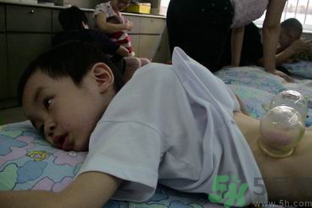 小孩可以拔罐嗎？寶寶能拔火罐嗎？