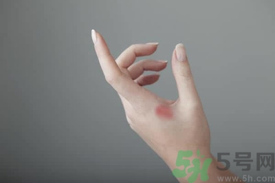 手被燙紅了怎么辦？手被燙了怎么止痛？