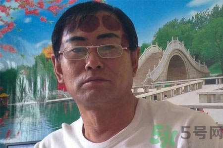 頭痛可以在額頭上拔火罐嗎？額頭上拔火罐有什么好處？