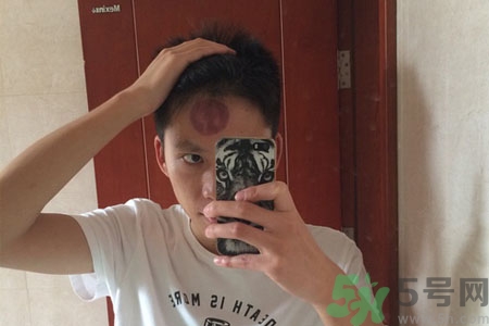 頭痛可以在額頭上拔火罐嗎？額頭上拔火罐有什么好處？