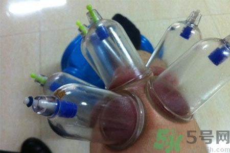 膝蓋能拔罐嗎？膝蓋疼可以拔罐嗎？