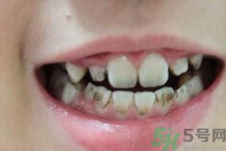小孩牙齒發(fā)黑怎么回事？小孩牙齒發(fā)黑怎么辦？
