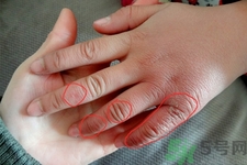 凍瘡為什么容易復(fù)發(fā)？?jī)霪彿磸?fù)發(fā)作怎么辦？