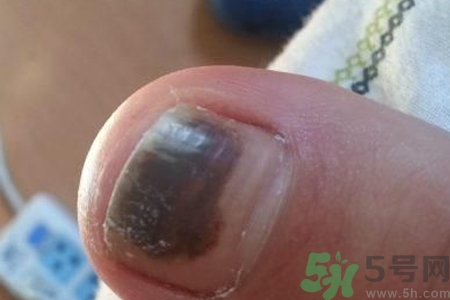 腳趾甲變黑是什么原因？腳趾甲變黑是怎么回事？