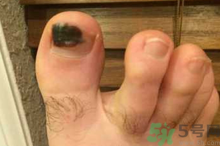 腳趾甲變黑是什么原因？腳趾甲變黑是怎么回事？