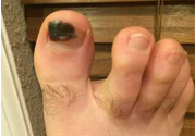 腳趾甲變黑是什么原因？腳趾甲變黑是怎么回事？