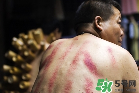 背部刮痧后能拔火罐嗎？背部刮痧后拔火罐有什么好處？