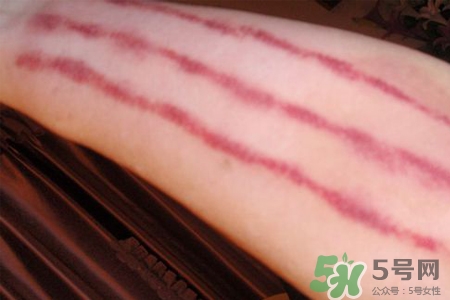 揪痧和刮痧哪個效果比較好？揪痧和刮痧的區(qū)別？
