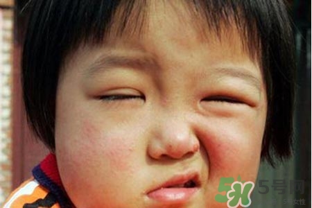 面癱能針灸嗎？針灸能治療面癱嗎？