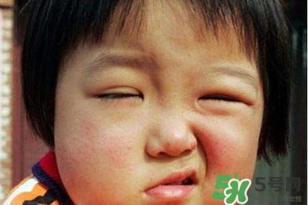 拔牙會(huì)導(dǎo)致面癱嗎?？拔牙為什么會(huì)導(dǎo)致面癱？