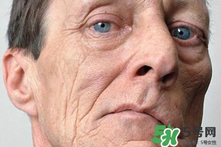 老年人為什么容易得面癱？老年人面癱原因有哪些？
