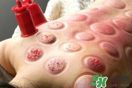 拔罐放血對(duì)身體好嗎？拔罐放血有什么好處？
