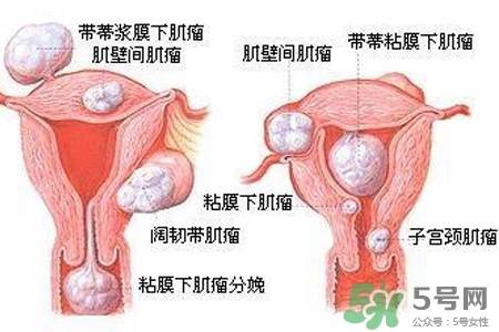 子宮小會影響生育嗎？子宮小會導(dǎo)致不孕嗎？