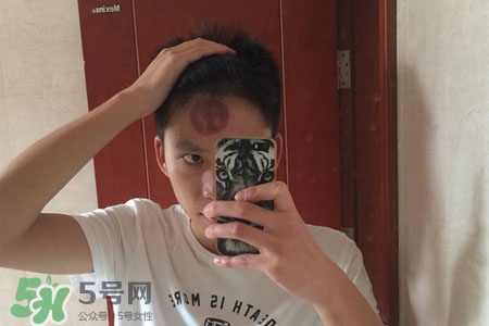 拔罐后皮膚癢能撓嗎？拔罐后身上癢切忌抓撓