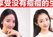 伊詩蘭頓祛痘怎么樣？伊詩蘭頓祛痘膏有用嗎？