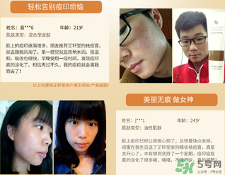 芷軒堂祛痘有效果嗎？芷軒堂祛痘印效果怎么樣？