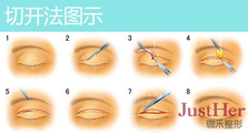 定點(diǎn)雙眼皮怎么做？定點(diǎn)雙眼皮需要拆線嗎？