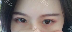 定點(diǎn)雙眼皮能保持多久？定點(diǎn)雙眼皮是永久的嗎？