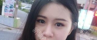 定點(diǎn)雙眼皮能保持多久？定點(diǎn)雙眼皮是永久的嗎？
