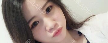 定點(diǎn)雙眼皮能保持多久？定點(diǎn)雙眼皮是永久的嗎？