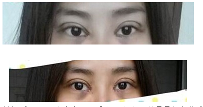 定點(diǎn)雙眼皮怎么做？定點(diǎn)雙眼皮需要拆線嗎？