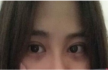 定點(diǎn)雙眼皮怎么做？定點(diǎn)雙眼皮需要拆線嗎？