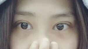 定點(diǎn)雙眼皮怎么做？定點(diǎn)雙眼皮需要拆線嗎？