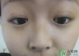 埋線雙眼皮需要拆線嗎？埋線雙眼皮怎么拆線
