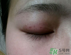 埋線雙眼皮需要拆線嗎？埋線雙眼皮怎么拆線