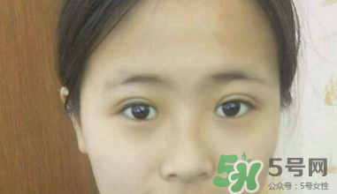 埋線雙眼皮需要拆線嗎？埋線雙眼皮怎么拆線
