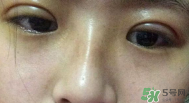 埋線雙眼皮需要拆線嗎？埋線雙眼皮怎么拆線