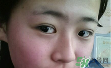 埋線雙眼皮需要拆線嗎？埋線雙眼皮怎么拆線