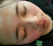 埋線雙眼皮需要拆線嗎？埋線雙眼皮怎么拆線