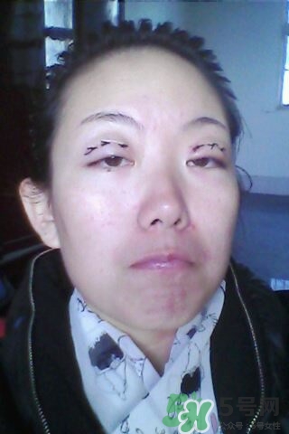 什么是定點(diǎn)雙眼皮？定點(diǎn)雙眼皮多少錢？