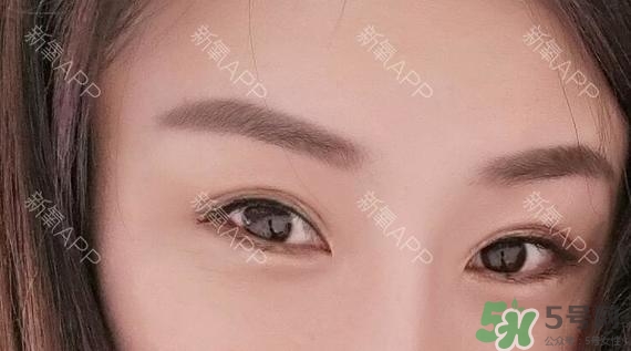 埋線(xiàn)雙眼皮能保持多久？埋線(xiàn)雙眼皮是永久嗎