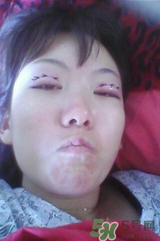 什么是定點(diǎn)雙眼皮？定點(diǎn)雙眼皮多少錢？