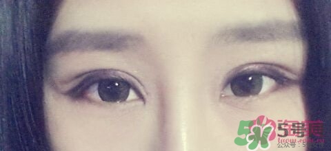 切開雙眼皮多久消腫？切開雙眼皮多久恢復？