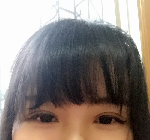 定點(diǎn)雙眼皮恢復(fù)過(guò)程圖_定點(diǎn)雙眼皮要多久恢復(fù)