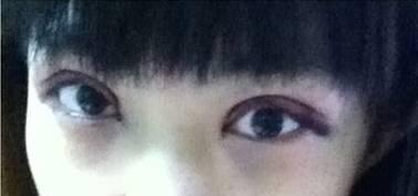 韓式三點(diǎn)雙眼皮是永久嗎？三點(diǎn)雙眼皮能保持多久？