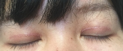 定點(diǎn)雙眼皮恢復(fù)過(guò)程圖_定點(diǎn)雙眼皮要多久恢復(fù)