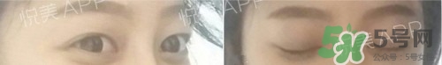 埋線雙眼皮多久恢復(fù)自然？埋線雙眼皮多久能恢復(fù)