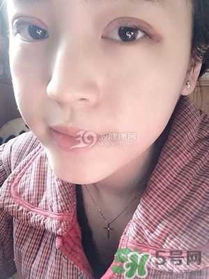 什么是定點(diǎn)雙眼皮？定點(diǎn)雙眼皮多少錢？