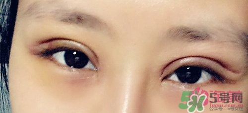 切開雙眼皮多久消腫？切開雙眼皮多久恢復？