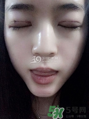 什么是定點(diǎn)雙眼皮？定點(diǎn)雙眼皮多少錢？