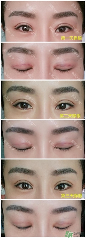埋線(xiàn)雙眼皮能保持多久？埋線(xiàn)雙眼皮是永久嗎